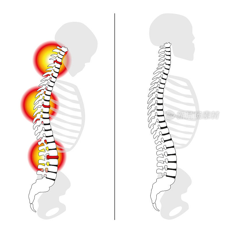 椎间盘突出，弯曲的背部，严重的背部疼痛-椎间盘突出与直立健康背部分离矢量图在白色背景。