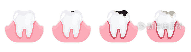 牙齿处于不同的蛀牙阶段。蛀牙,牙痛。深龋齿和讲坛。平面风格的矢量插图孤立在白色上。