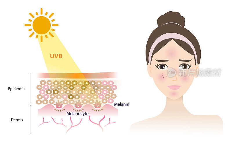 UVB射线穿透皮肤层和损害妇女的脸矢量在白色背景。