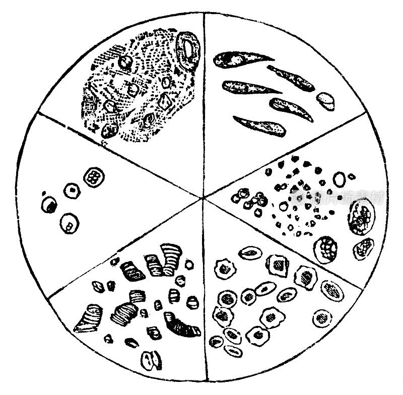 19世纪人类尿液中各种铸型的显微观察