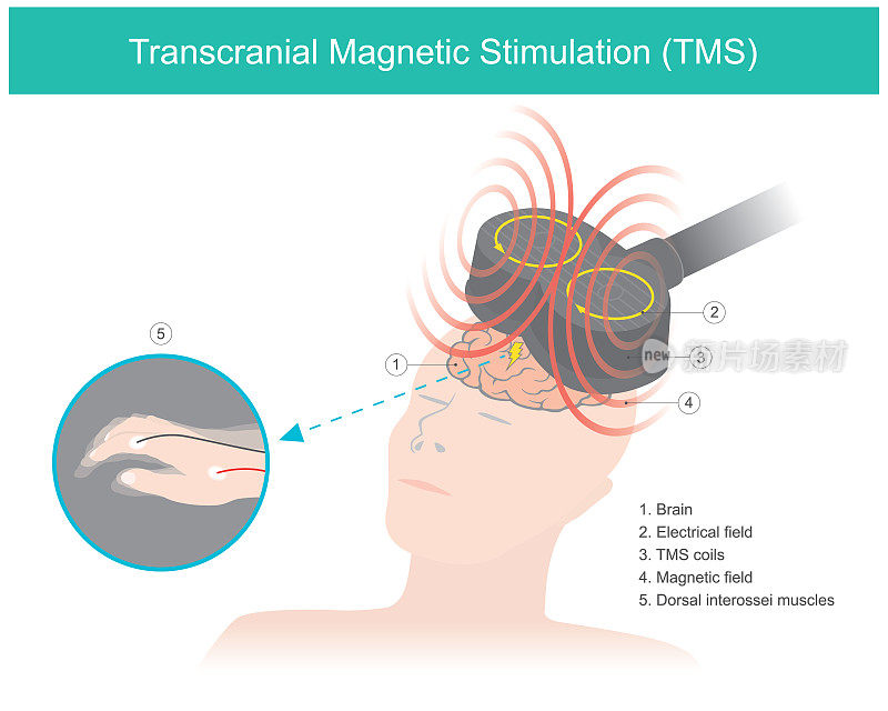 经颅磁刺激(TMS)。