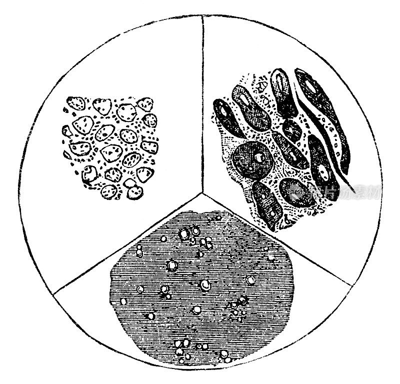 19世纪人类尿液中白细胞(脓尿)、脂肪细胞(脂质尿)和上皮细胞的显微观察