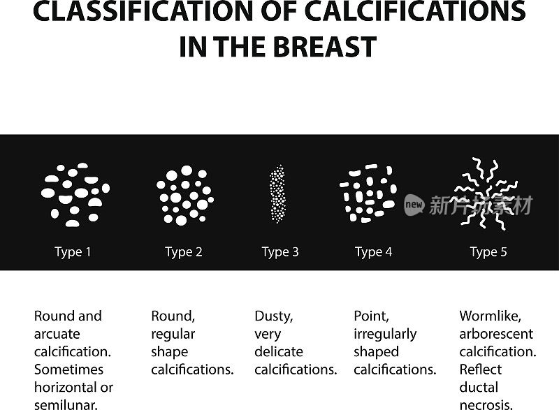 乳腺钙化的分类。乳房x光检查。乳腺。信息图。矢量插图在孤立的背景