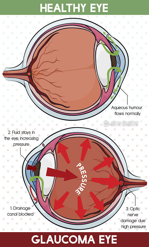 健康眼与青光眼的比较信息