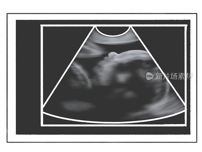 胎儿的超声波扫描;怀孕9个月