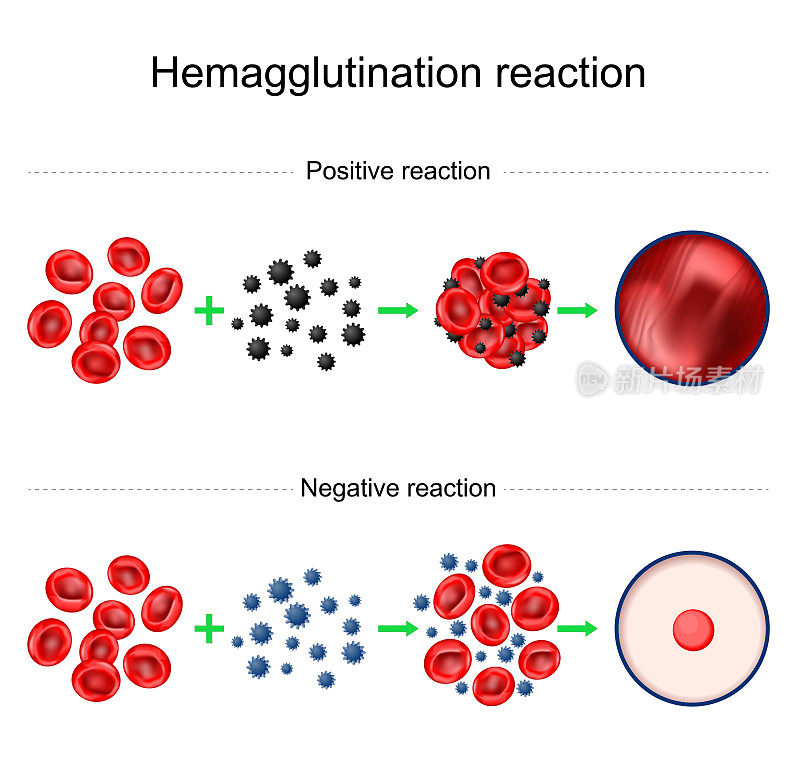 红细胞凝集反应。血液输入。