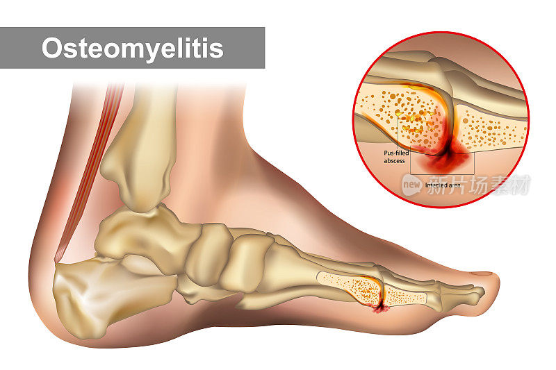 骨髓炎是一种骨骼感染。图示人类足部骨髓炎。