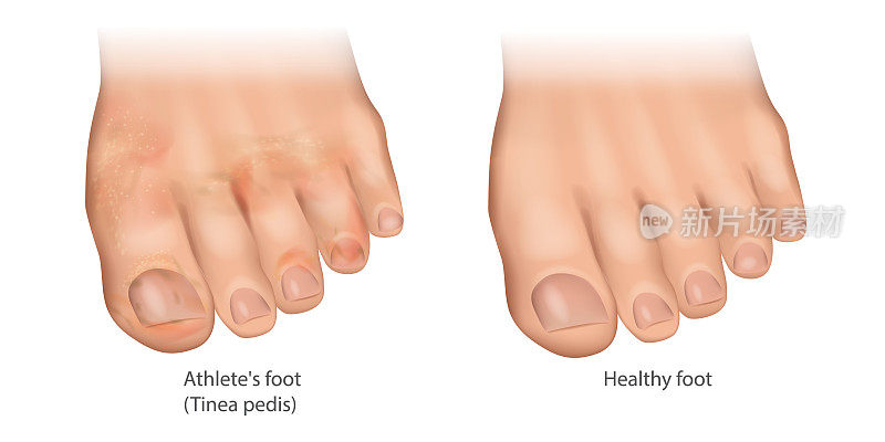 香港脚和健康脚的图示。足癣或足癣，鹿皮鞋足。脚部皮肤感染