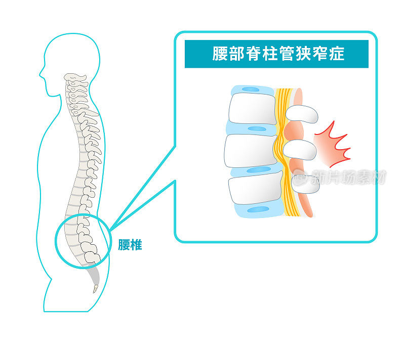 腰椎管狭窄图示