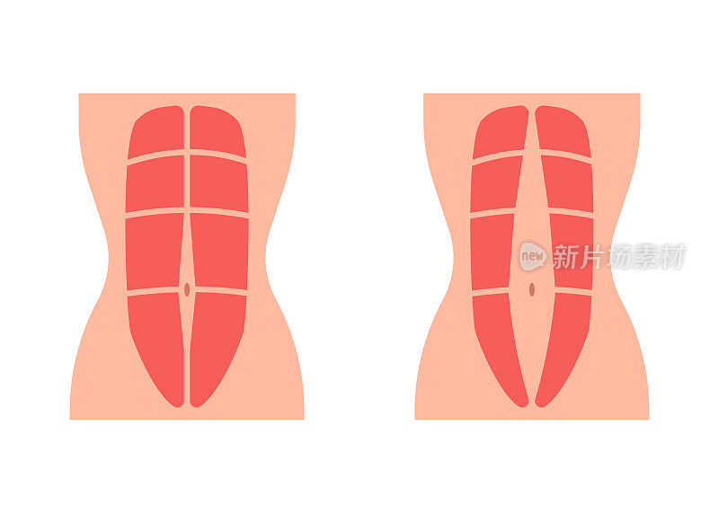 腹肌张力正常，腹肌伸展直，腹肌无力，腹肌发散。腹直肌腹部心休息期。矢量图