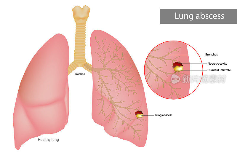 肺脓肿是肺组织液化性坏死的一种。肺内有脓性浸润和坏死腔。肺部疾病