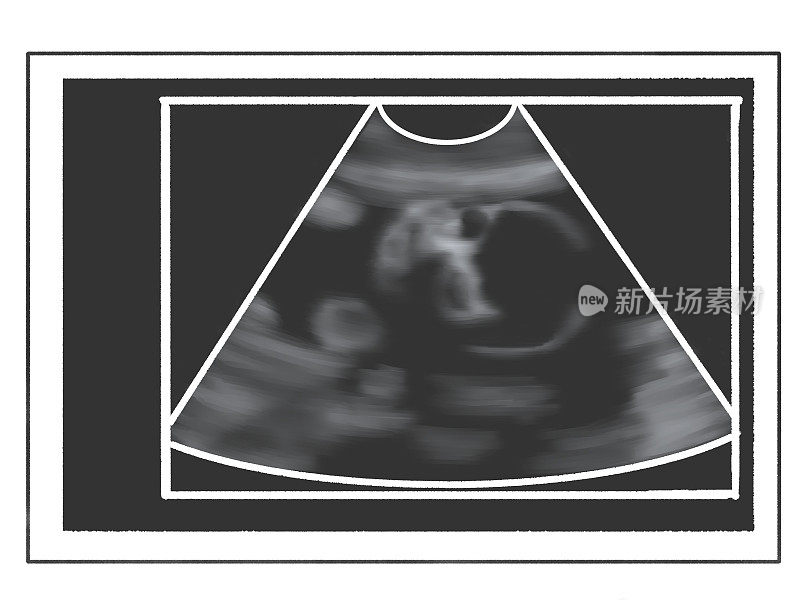 胎儿的超声波扫描;怀孕23周