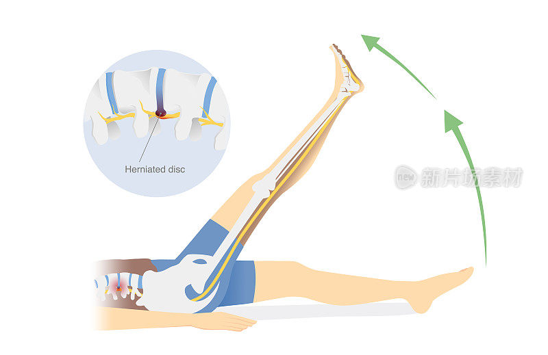 人们做坐骨神经痛伸展来缓解椎间盘突出的疼痛。抬腿治疗背痛的练习图。物理治疗。