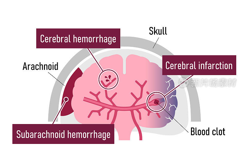 人类脑卒中类型矢量图解