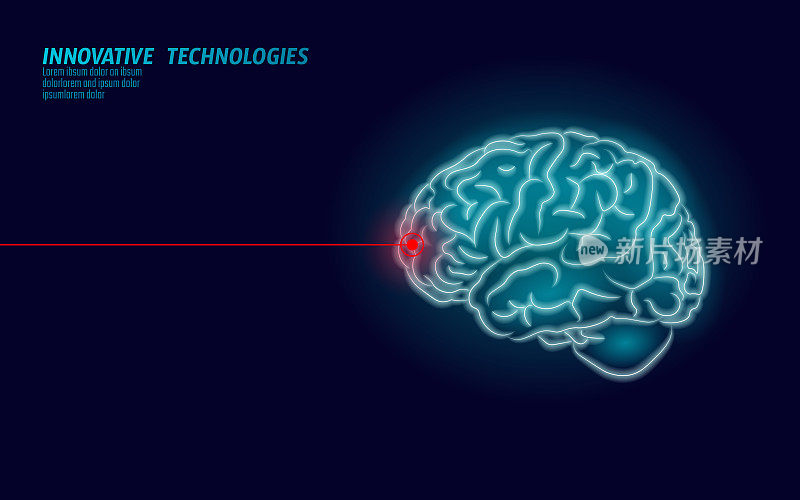 激光外科医生大脑治疗低聚3D渲染。药物益智人能力聪明心理健康。医学认知康复在阿尔茨海默病和痴呆矢量插图
