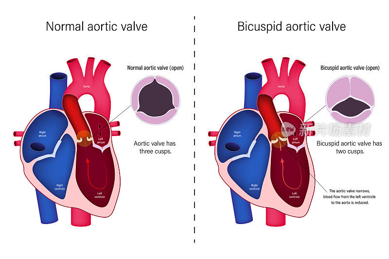 正常心脏瓣膜与二尖瓣主动脉瓣载体的差异。先天性心脏病。主动脉瓣狭窄。