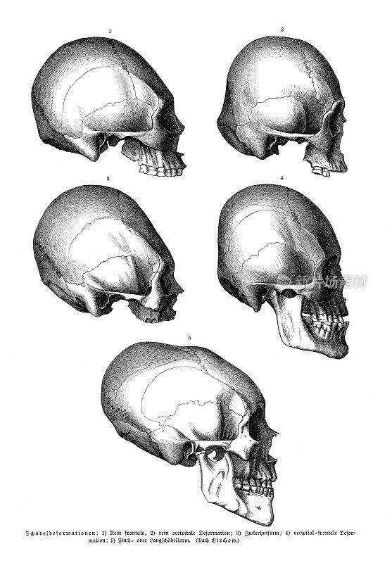 1886年的畸形人头骨收藏