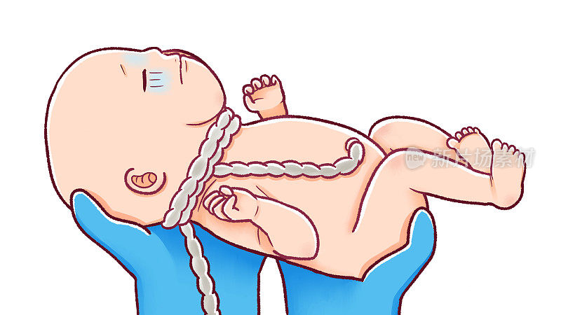 颈背的线;带脐带的新生儿