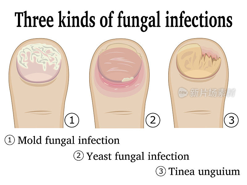 三种真菌感染