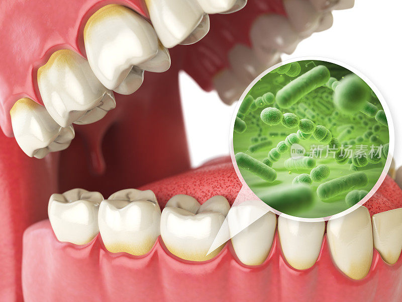 牙齿周围有细菌和病毒。牙科卫生医学概念。