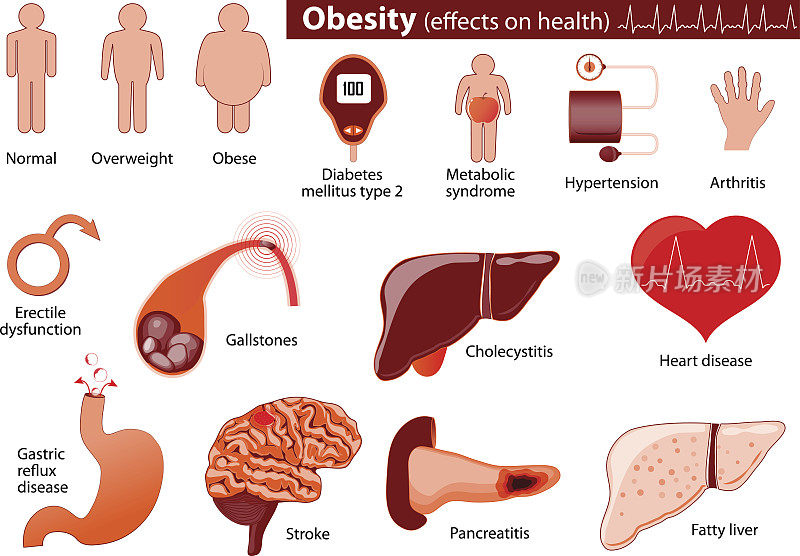 肥胖和超重信息图表