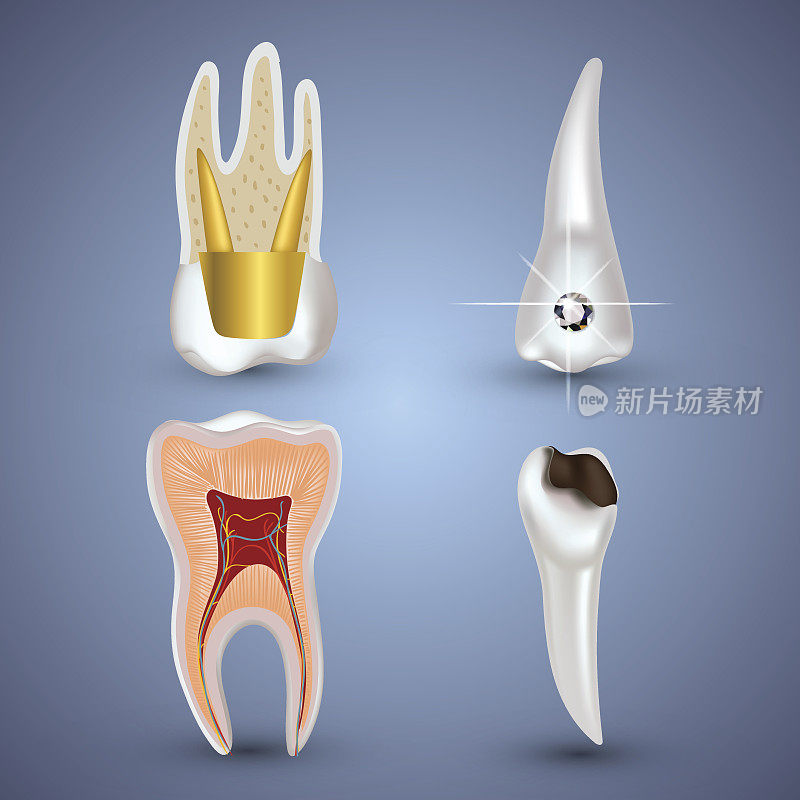 向量集的3d现实清洁和肮脏的牙齿孤立在灰色的背景。牙齿健康的概念。口腔护理，牙齿修复