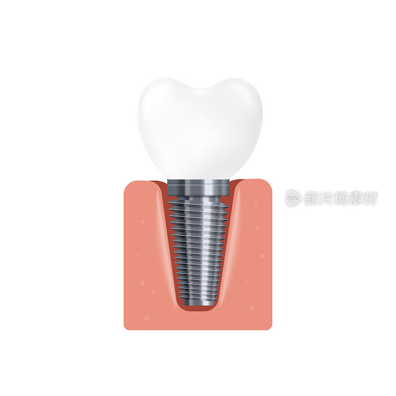逼真的3d孤立矢量插图的牙科种植在牙龈