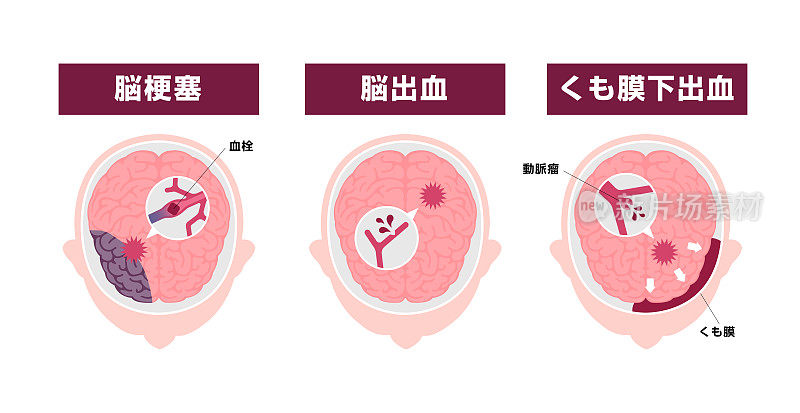 人类脑卒中类型矢量图解