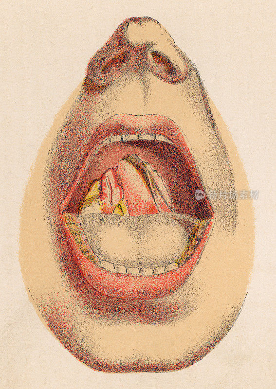 19世纪先天性梅毒患者口腔腭溃疡的医学插图