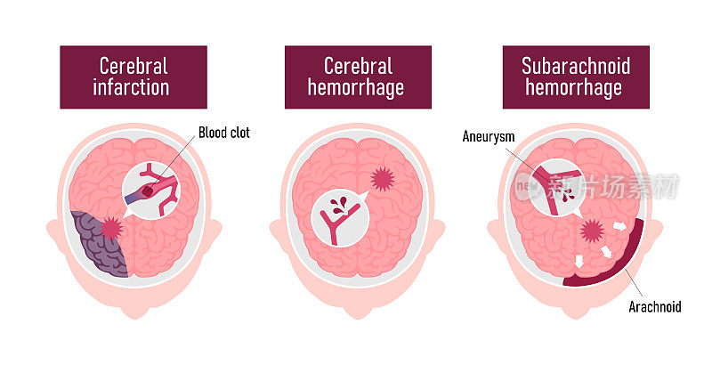 人类脑卒中类型矢量图解