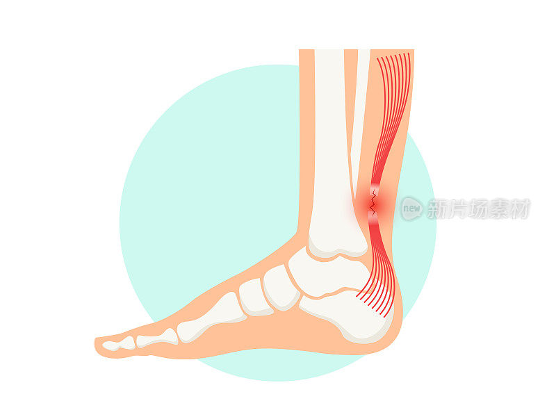 跟腱断裂解剖海报。脚踝受伤，韧带扭伤和撕裂问题