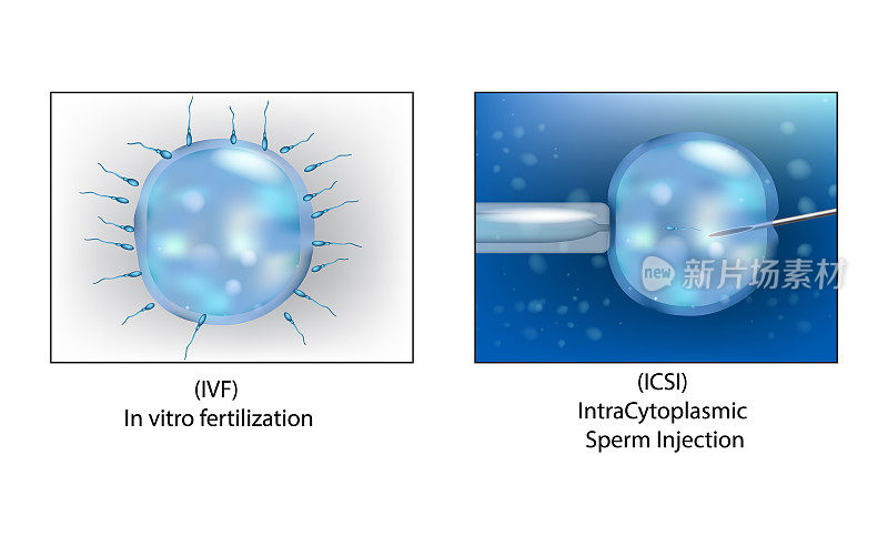 (ICSI)胞质内精子注射和体外受精。