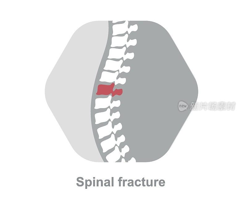脊柱骨折和创伤性椎体损伤医学概念，在白色背景上