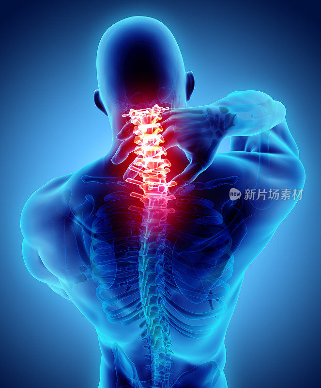 颈部疼痛-颈椎骨骼x光，3D插图。