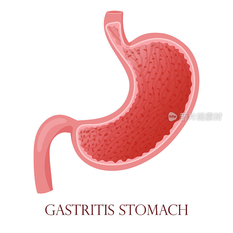 胃炎粘膜细胞炎症图示