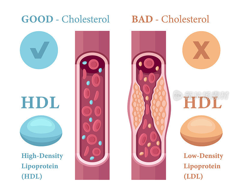 血液中胆固醇的种类。高密度脂蛋白(HDL)和低密度脂蛋白(LDL)。