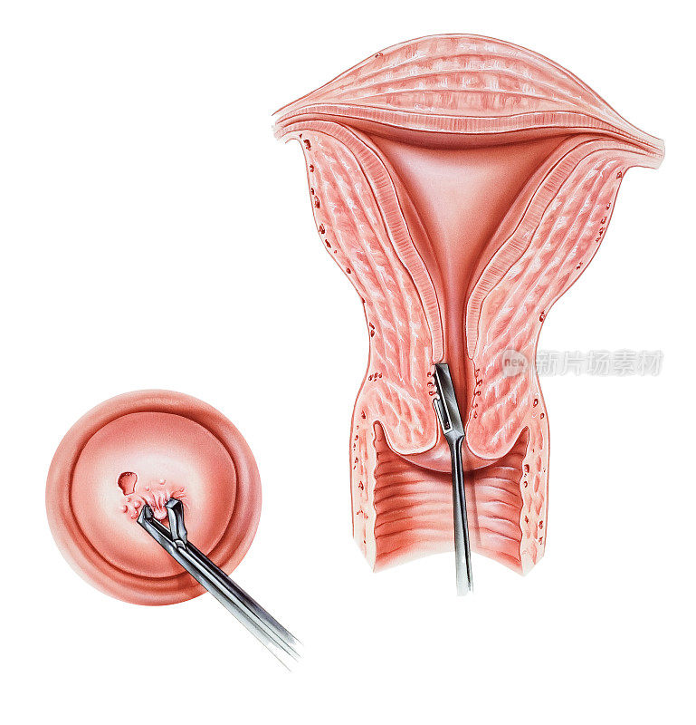 宫颈和宫颈内膜-活检