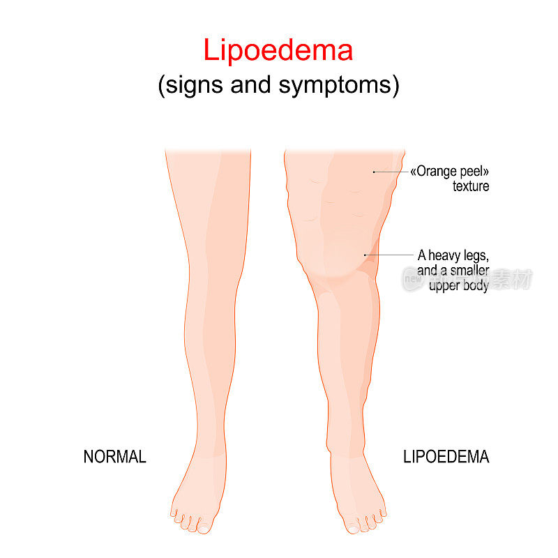 Lipedema或Lipoedema。