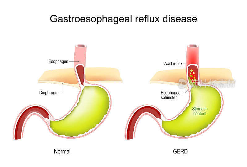 胃食管反流病。GERD