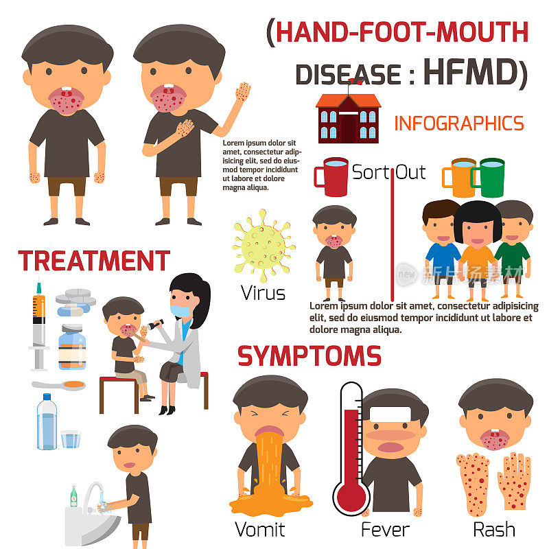 手足口病儿童感染。海报详细的手足口病信息图与症状预防和治疗。卡通健康概念矢量插图。