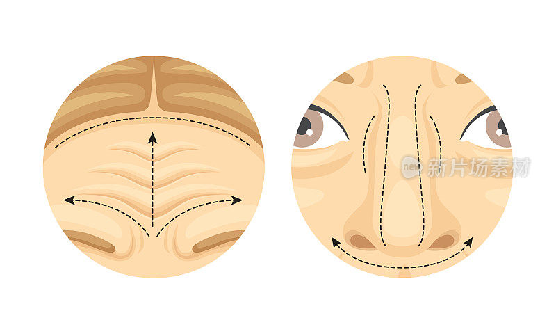 圆形向量集中的整形外科作为人额头和鼻子的恢复与重建
