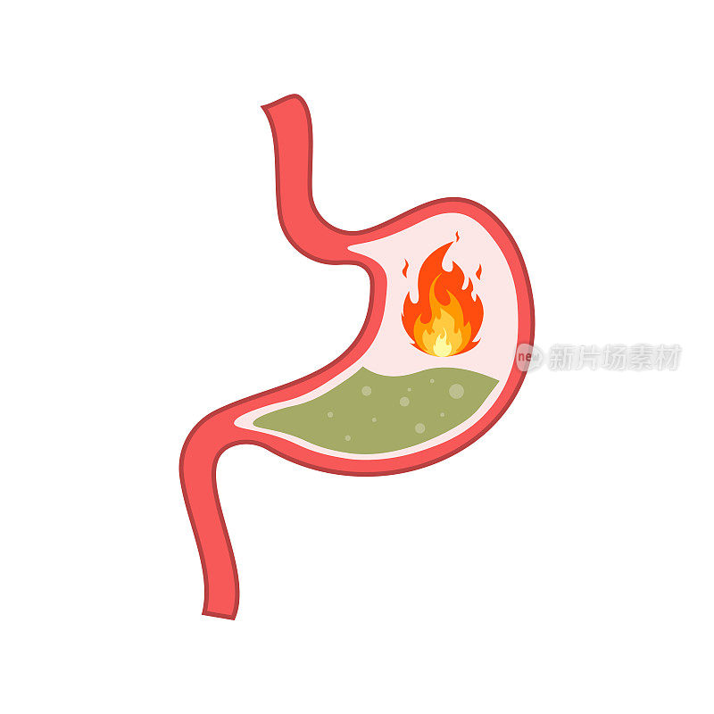 胃酸反流或烧心和胃炎。消化不良和胃痛问题的概念。孤立的矢量图