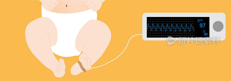 新生儿脉搏血氧监测。放置在新生儿脚部的传感器和血氧计显示血氧饱和度和血氧饱和度
