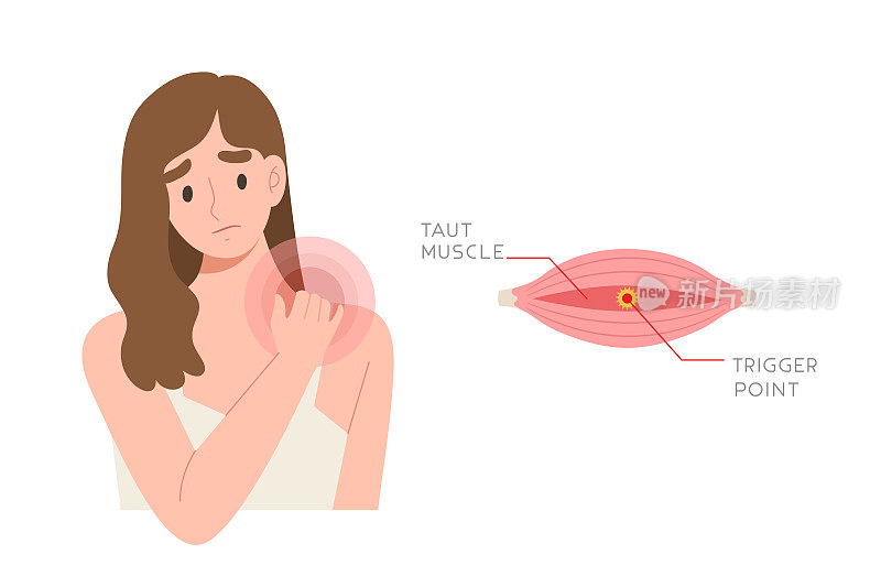 有颈部和肩部疼痛的年轻女性，并有肌肉触发点引起疼痛的信息图。