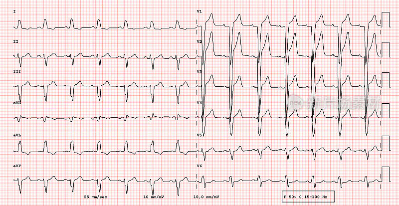 心电图12导联节律，左束支阻滞