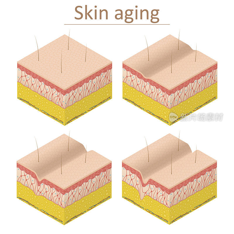 皮肤老化设置等距视图。向量