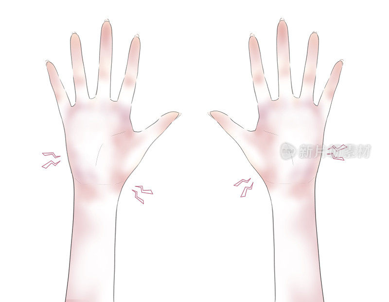手部皲裂发炎发红的图示(3)