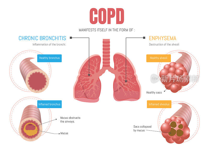 Epoc信息图:表现为肺气肿和支气管炎两种形式