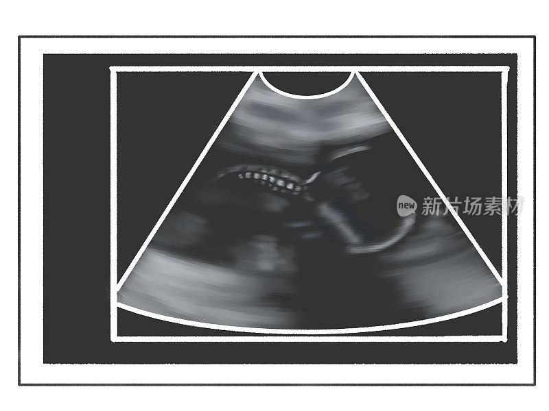 胎儿的超声波扫描;怀孕20周
