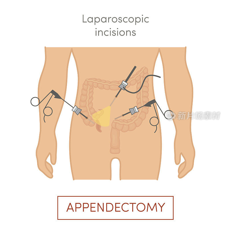 腹腔镜阑尾切除术-阑尾切除